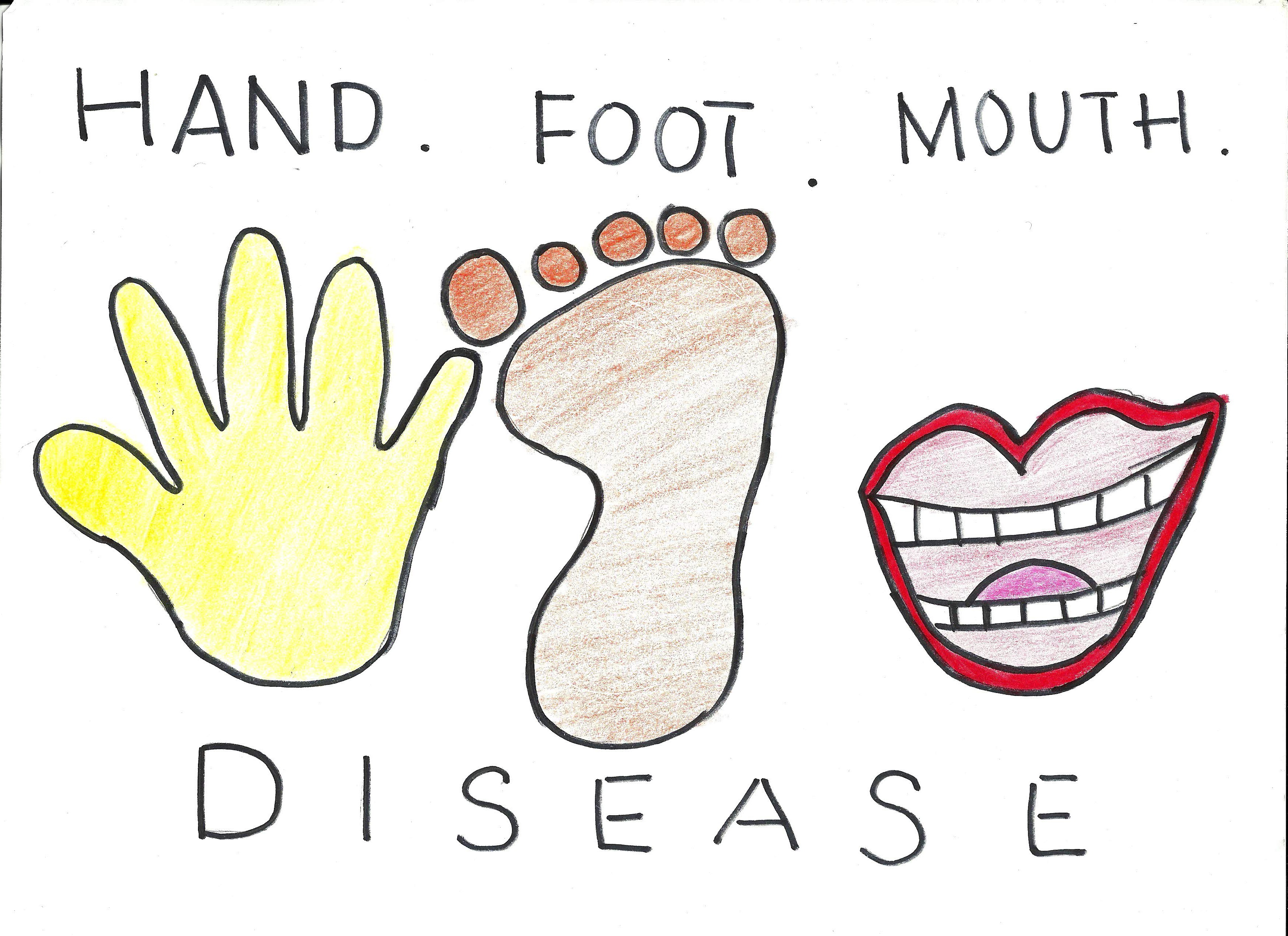 hand foot mouth disease baby